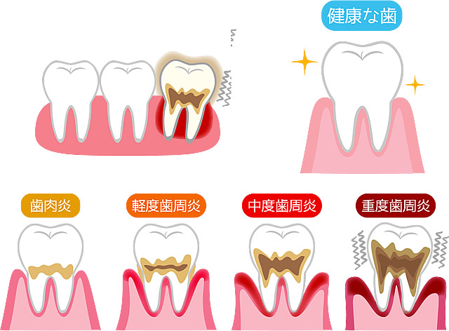 歯周病
