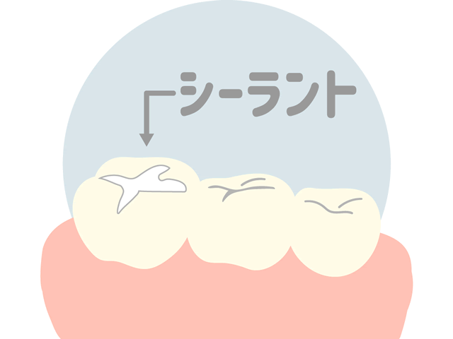 シーラント